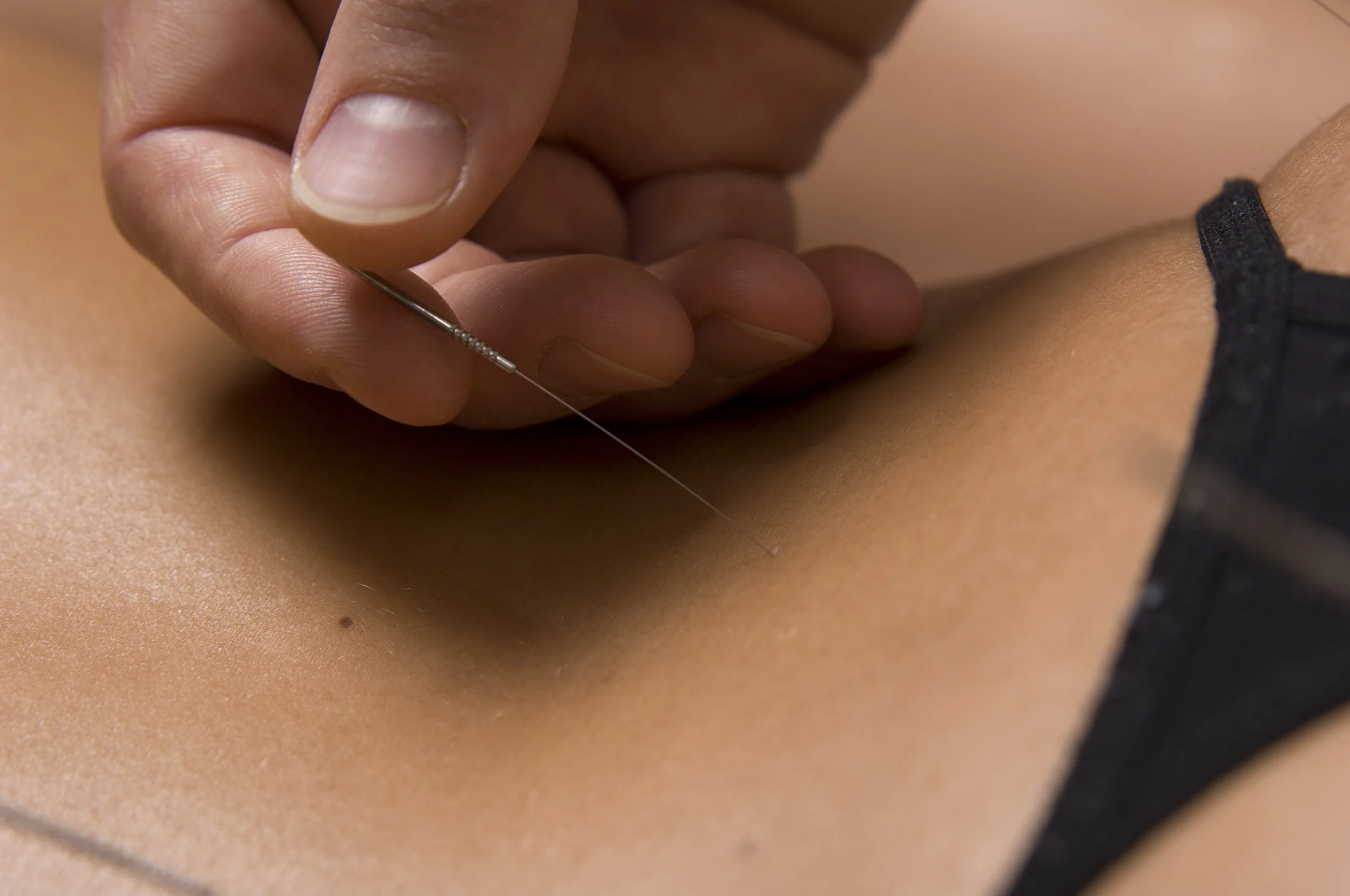Close-up of an acupuncture needle being inserted during treatment